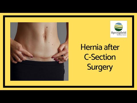 Video: Hernia Efter C-sektion: Symptomer Og Behandling