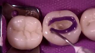 Class 1 composite restoration (perfect technique of restoration)