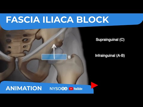Scanning principles for Infrainguinal vs. Suprainguinal Fascia Iliaca block - NYSORA's Animations