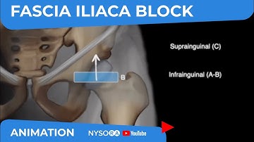 Scanning principles for Infrainguinal vs. Suprainguinal Fascia Iliaca block - NYSORA