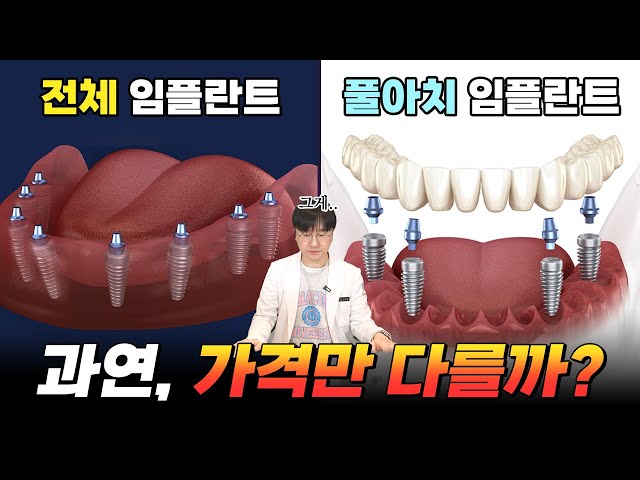 강남역치과 디지털 풀아치 임플란트, 치과의사가 추천할까❓ | 전체임플란트, 틀니