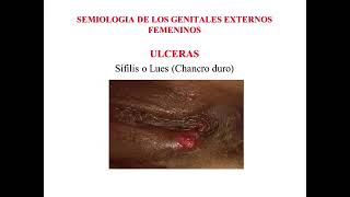 SEMIOLOGÍA GENITALES EXTERNOS FEMENINOS