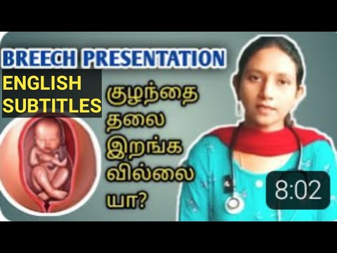 breech presentation tamil