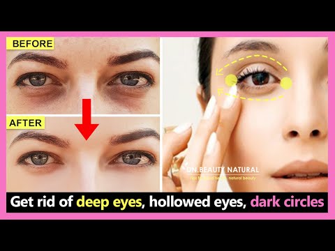 How to get rid of deep eyes, hollowed eyes, dark circles and wrinkles under the eyes | Eye exercises