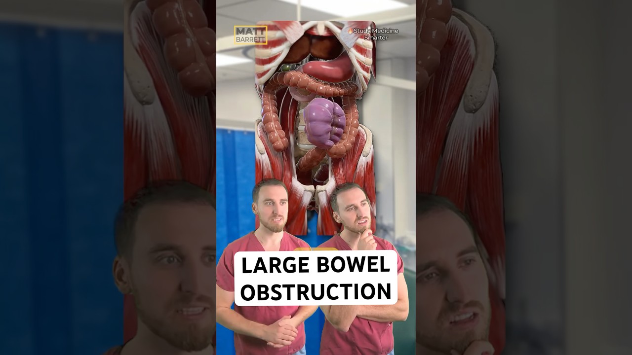 Easily remember large bowel obstruction causes