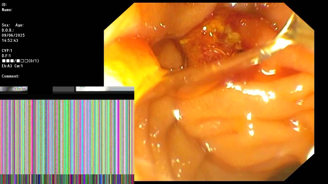 ERCP ; Intra and extrahepatic cholangiocarcinoma with suppurative cholangitis from CBD obstruction.