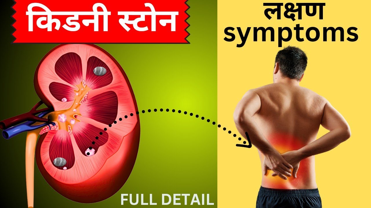 किडनी स्टोन के लक्षण पथरी शुरुआती लक्षण kidney stone in hindi