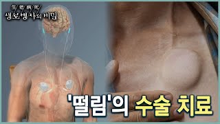 본태성 떨림과 근긴장이상증, 어떻게 치료할까 (KBS 20221109 방송)