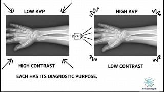 kVp & mAs Explained: How to Balance Image Quality and Patient Safety