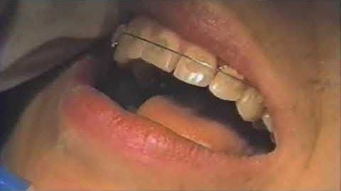 Wire Bending: 2nd Order Bends