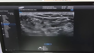 Hydrodissection of tibial nerve at knee
