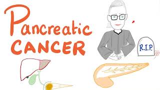 Pancreatic Cancer | Symptoms, Signs, Diagnosis, Management