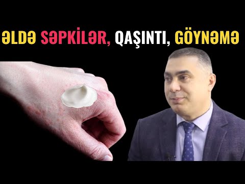 Əllərində səpgi, qaşıntı, göynəmə olanlar MÜTLƏQ BAXIN -  Ekzema nədir?