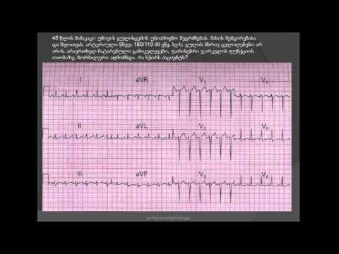 ეკგ. სინუსური ტაქიკარდია და ფეოქრომოციტომა- sinusuri taqikardia da feoqromocitoma