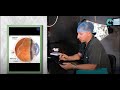Retinal Detachment Surgery: What to Expect (Part 1)