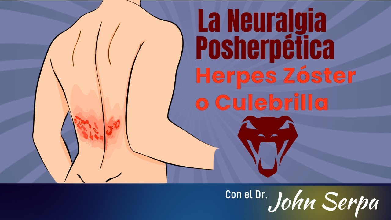 Neuralgia Postherpetica.. Lo que pasa después de la "Culebrilla"