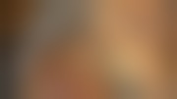 ArtiSential assisted laparoscopic Low Anterior Resection with TME