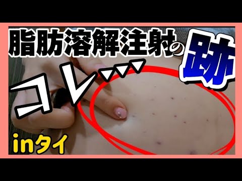 【痩せるか検証！】部分痩せしたいから、お腹に大量の脂肪溶解注射打ってみた！