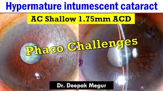 Intumescent cataract (Extremely shallow anterior chamber) Dr. Deepak Megur