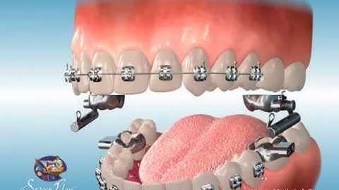 ScreenPlay Orthodontic Education Videos: AdvanSync Brackets