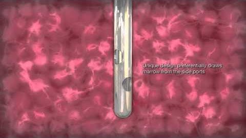 DG Medical Animations: Ranfac Marrow Cellution (Bone Marrow Aspiration)