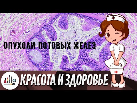 Опухоли потовых желез