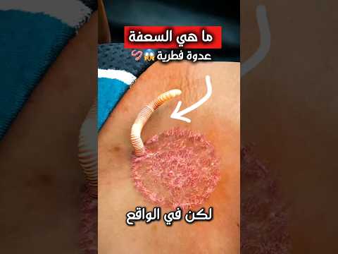 ما هي السعفة موضحة