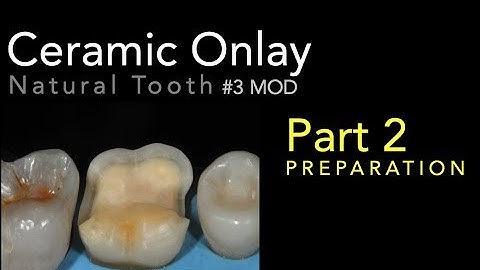 Lithium Disilicate Ceramics, Part  2: Ceramic Onlay Preparation