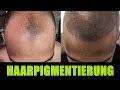 Mikro Haarpigmentierung - Alternative zur Haartransplantation?