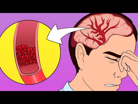 Video: Il plesso può causare mal di testa?