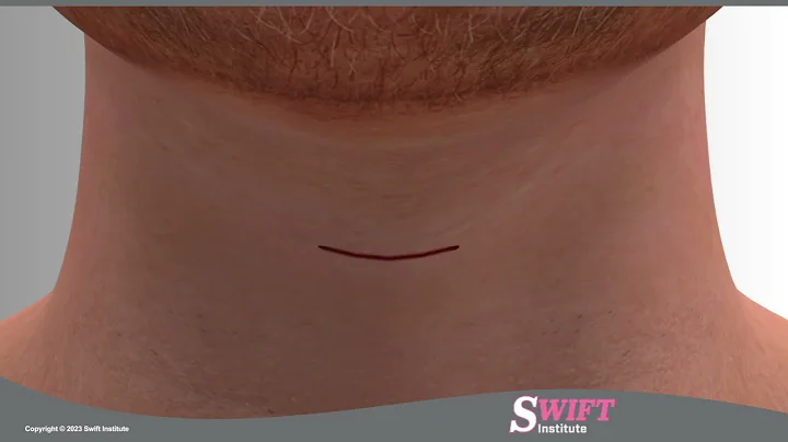 Anterior Cervical Discectomy and Fusion ACDF - Reno, Carson City, Nevada