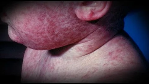 Quanti casi di morbillo ci sono in Italia?