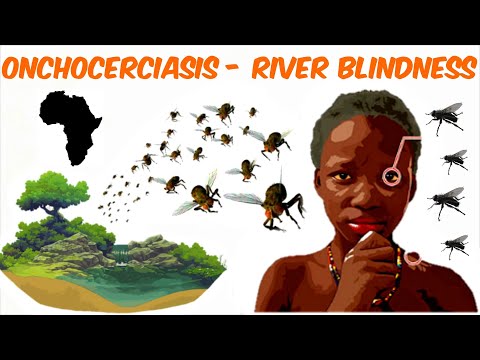 Wideo: Onchocerciasis (River Blindness): Objawy, Przyczyny I Więcej