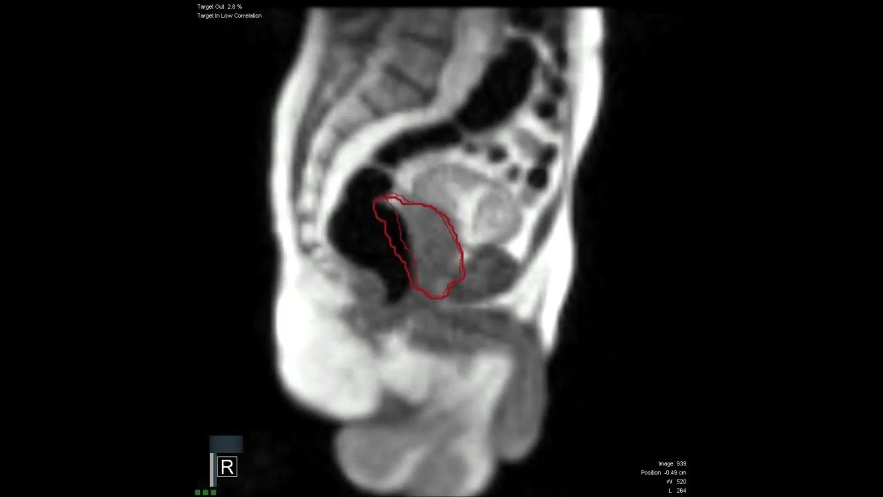 significant-rectal-distension-bowel-gas-movement-moving-prostate