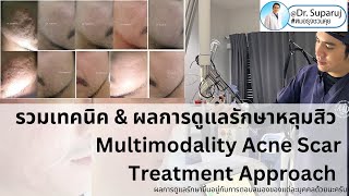 เทคนิค & ผลการรักษาหลุมสิวแบบองค์รวม Multimodality Acne Scar Treatment Approach หมอรุจชวนคุย