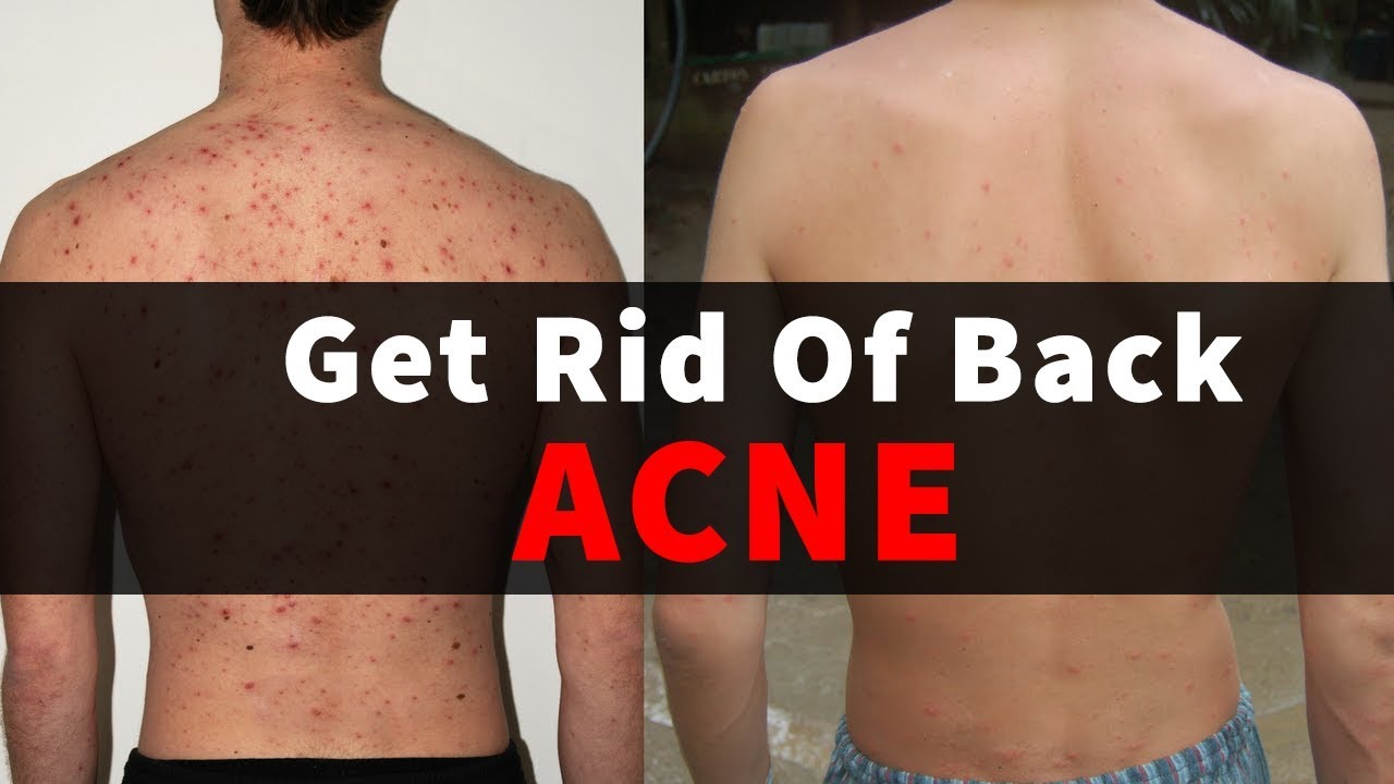 How To Get Rid Of Back Acne Fast Naturally At Home