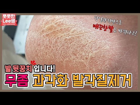 갈라지는 발뒷꿈치! 무좀 과각화 발각질제거 매끈한발로 바꿔드릴게요 removal of callus - Fresh Foot 성수점 / 남양주호평점