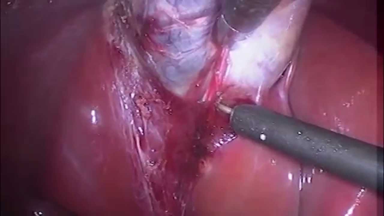 Cálculo de vesícula biliar (litiase biliar) / Gallstones doutor estranho filme