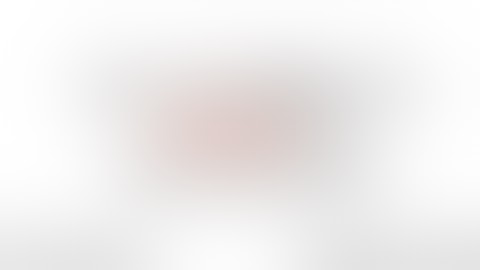 Bypass - Side to side single suture A2 bypass for Giant A2 Aneurysm