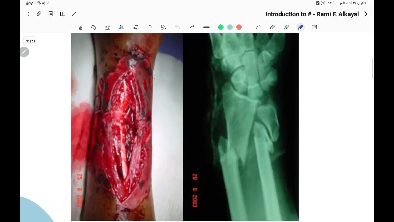 Lec.1 || Introduction To Fracture - Part 1 || Orthopedic
