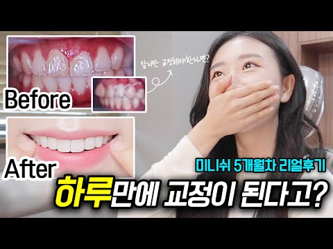 미니쉬 5개월차 리얼후기 | 치아미백,<strong>잇몸성형</strong>, 금니교체