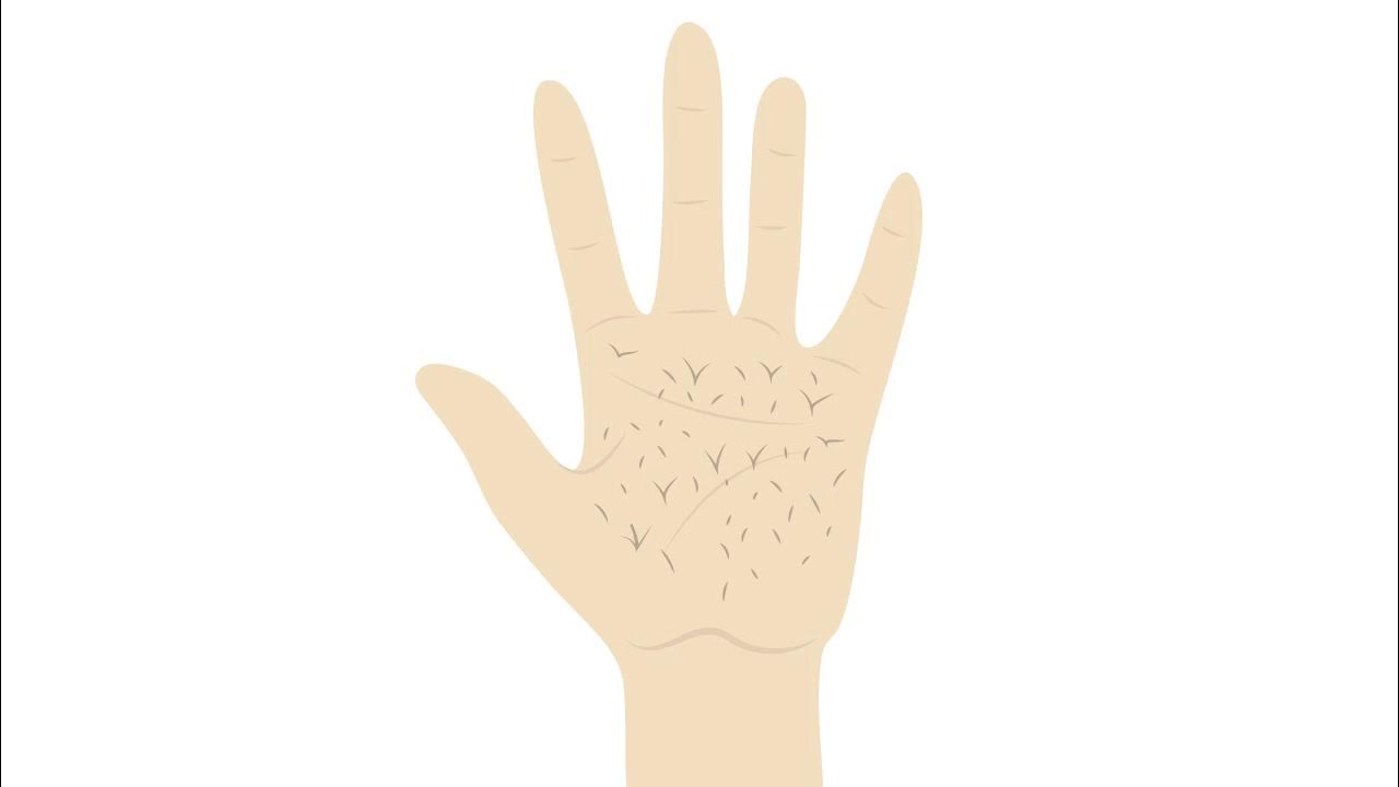 Hawkins v. McGee Case Brief Summary Law Case Explained YouTube