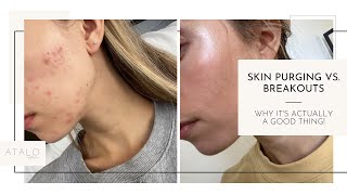 Skin Purging vs. Breakouts- What's the Difference?