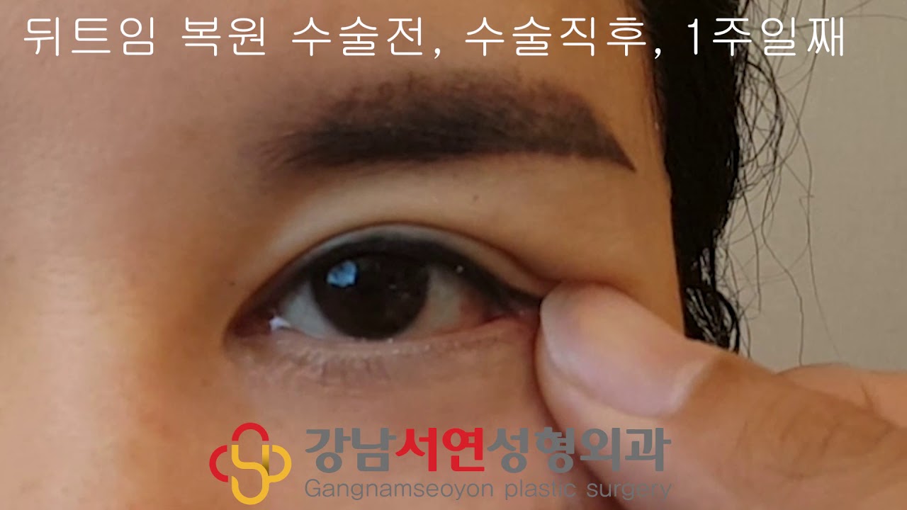 [Gangnam Seoyeon Plastic Surgery] Phẫu thuật phục hồi khoé mắt ngoài, phẫu thuật tái tạo khoé mắt ngoài, Bệnh viện phẫu thuật thẩm mỹ Gangnam Seoyeon, cố định khóe mắt ngoài, lateral canthoplasty, gangnam seoyon plastic surgery. Trước phẫu thuật, ngay sau phẫu thuật, 1 tuần sau phẫu thuật.