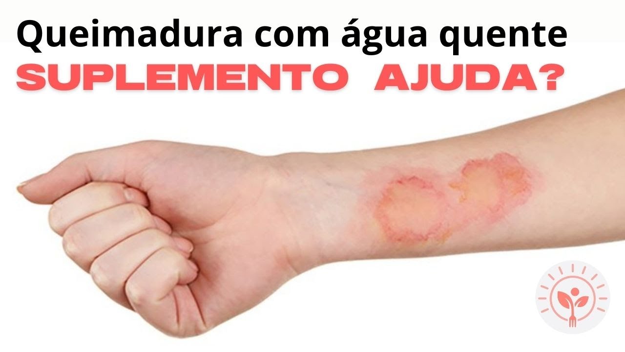 DICA PARA RECUPERAÇÃO DA PELE APÓS QUEIMADURA COM ÁGUA FERVENDO (CAFÉ ...