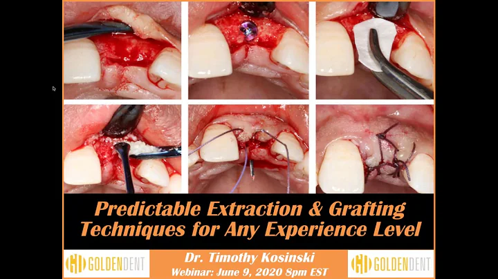 Webinar: June 9, 2020 Dr. Tim Kosinski - Extractio...