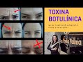 Toxina Botulínica antes e depois em glabela. Quando é a hora certa de aplicar? rugas x BOTOX
