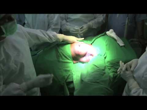 Video: Areola Reduksjon Kirurgi: Teknikk, Risiko, Utvinning Og Mer