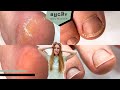 SUPER DEEP CRACKS, Complete Pedicure Transformation W/ Disks