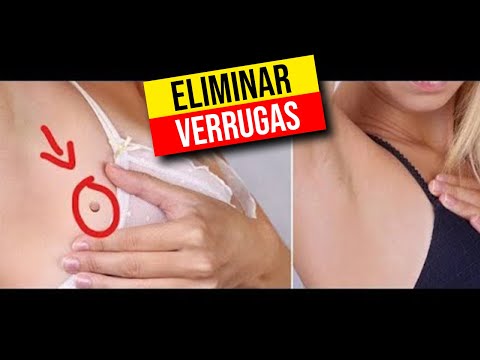 Por qué salen las verrugas en el cuello